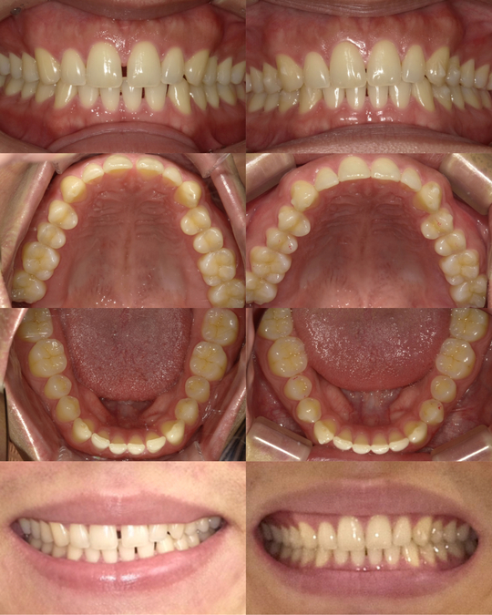 矯正歯科 治療例紹介 - マウスピース矯正 横浜さいとう矯正歯科